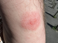 Tick bite on the forearm of a man in Toronto, Ontario, Canada, on July 07, 2023. Experts predict bad year for ticks as disease-carrying bugs...