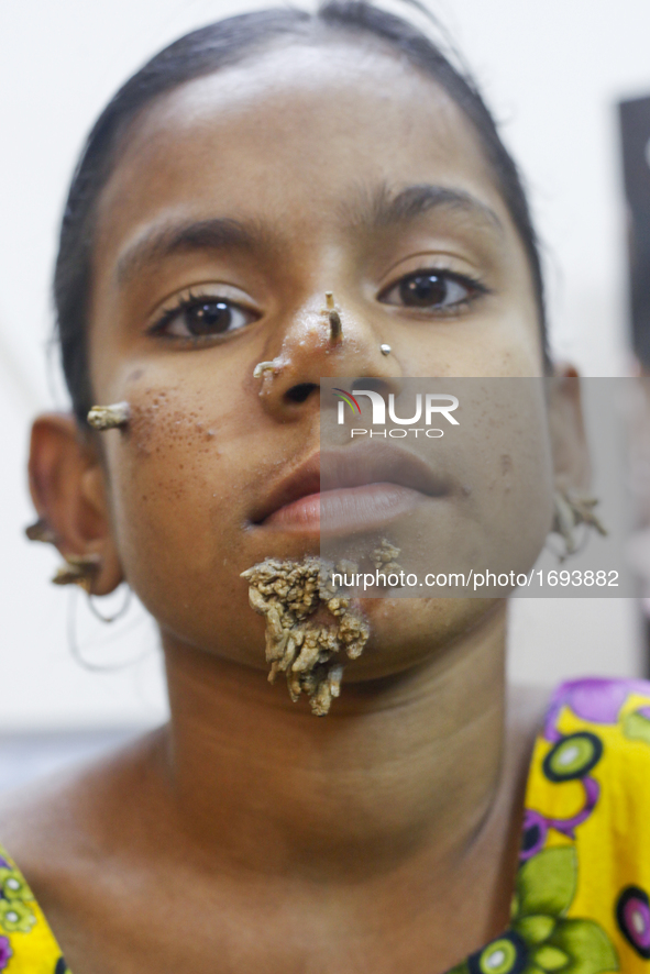 Doctors in Bangladesh will form a medical board to assess a 10-year-old girl with bark-like warts growing out of her face, believed to be tr...
