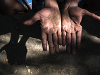 A pair of hardworking hand is highly affected due to arsenic contaminated water use. Gaighata, West Bengal, on India 2 April 2017.  Gaighata...
