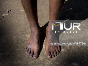 A pair of feet depicts the deadly scars of arsenic poisoning.Gaighata, West Bengal, on India 2 April 2017.  Gaighata, a village in north 24...