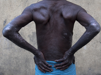 An arsenic affected villager is showing his scar spread all over his back and both of his hands. Gaighata, West Bengal, on India 2 April 201...