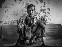 (EDITORS NOTE: Image has been converted to black and white.) Abul Bajandar, age 29, who suffers from rare skin dosorder known as tree man sy...