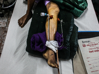 A man with his broken leg is taking treatment who is a victim of nepal earthquake at Bir Hospital, Kathmandu, Nepal, 8 May 2015. (