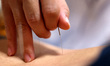 A doctor performs acupuncture on a patient in Zaozhuang City, Shandong Province, China, on...