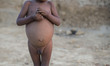 Three years old Osman Gani suffers from malnutrition at Kutupalong Refugee Camp, Cox's Baz...