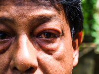 Amid heavy rainfall in West Bengal over the past few weeks, numerous cases of conjunctivitis are being reported per day. Conjunctivitis, or...