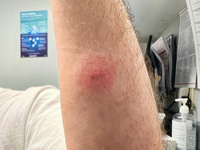 Tick bite on the forearm of a man in Toronto, Ontario, Canada, on July 07, 2023. Experts predict bad year for ticks as disease-carrying bugs...