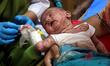 Children infected with measles receive treatment at the Infectious Disease Hospital in Dha...