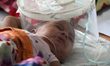 Children suffering from measles and related complications receive treatment at the pediatr...