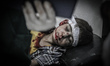 A wounded boy is treated at hospital after Assad forces barrel bomb attack to Arbil distri...